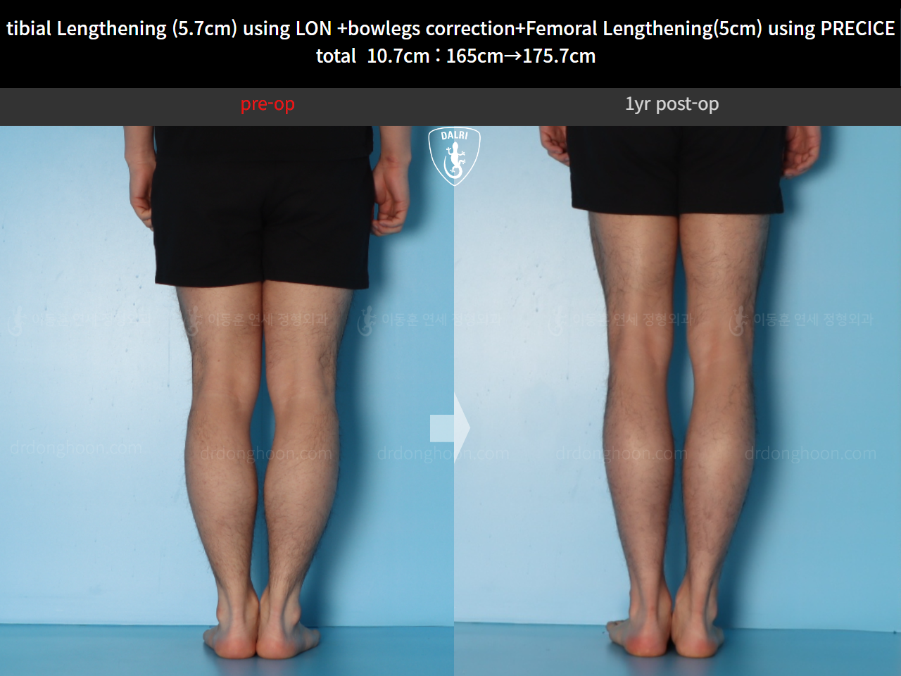 Before and after cll precice, case 20363375, image 8, Dr. Donghoon institute (DALRI)