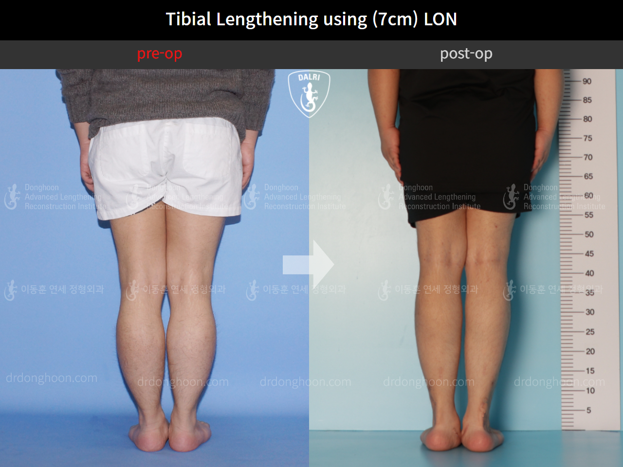 Before and after cll lon, case 10452499, image 5, Dr. Donghoon institute (DALRI)