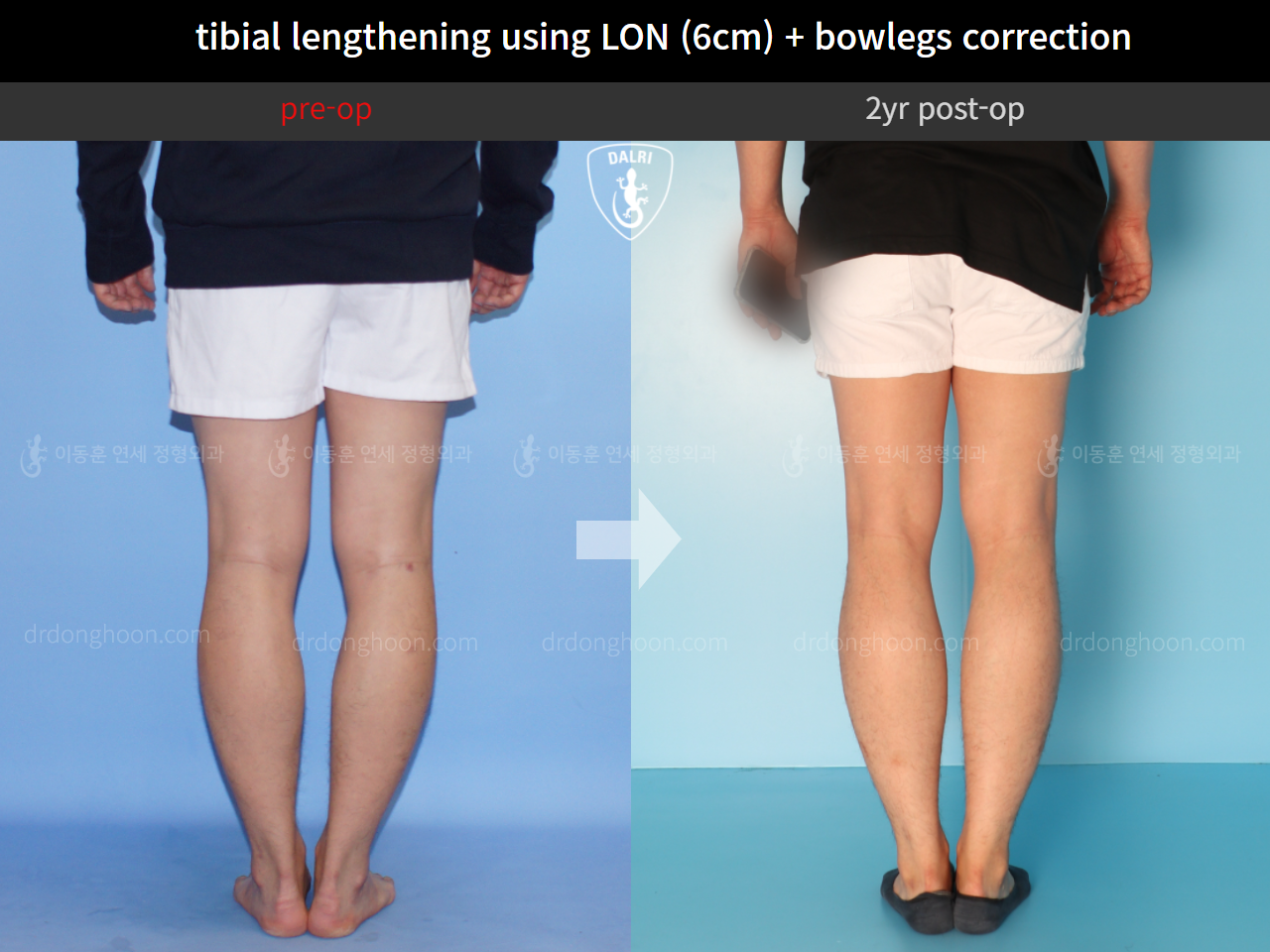 Before and after cll + deformity correction, case 4323155, image 6, Dr. Donghoon institute (DALRI)