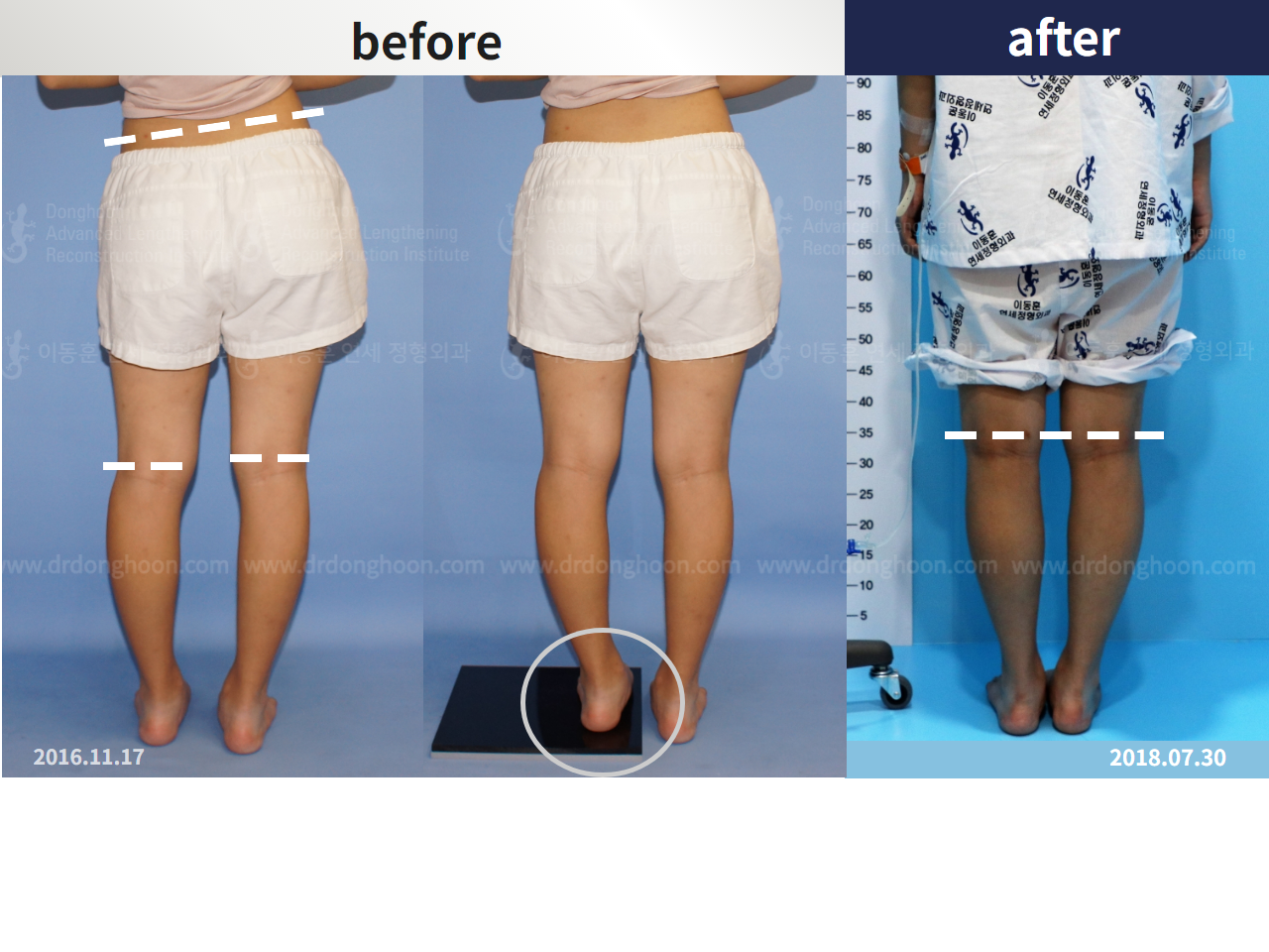 Before and after complex deformity, case 4297336, image 3, Dr. Donghoon institute (DALRI)