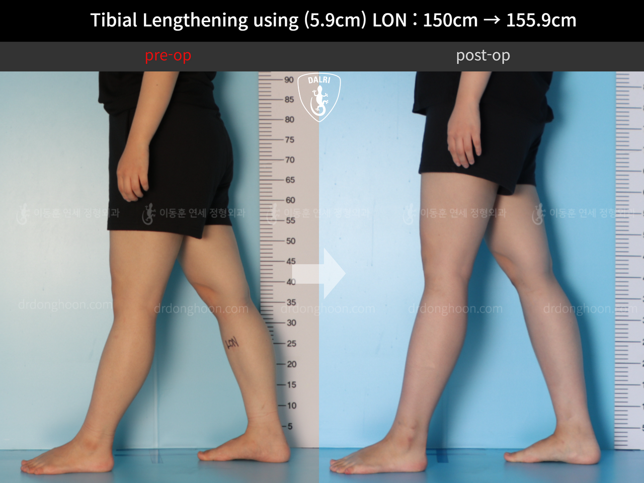 Before and after cll lon, case 12207071, image 8, Dr. Donghoon institute (DALRI)