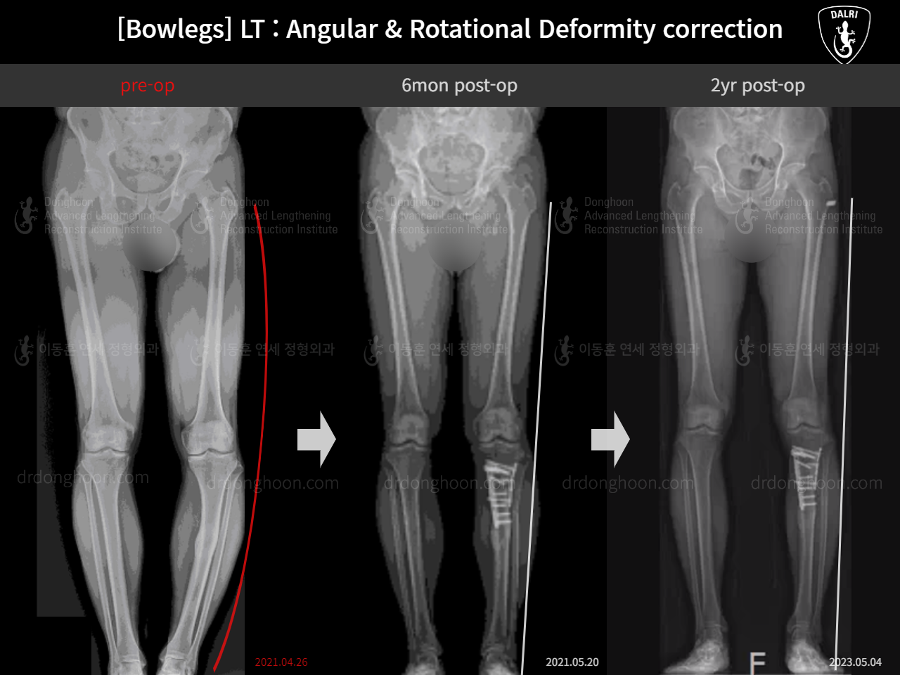 Before and after adult bowlegs, case 15111863, image 10, Dr. Donghoon institute (DALRI)