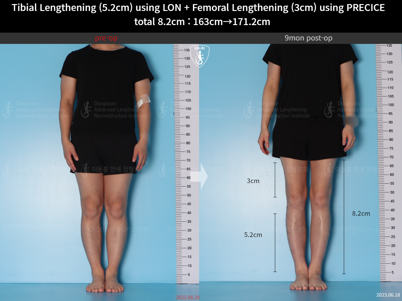 Before and after cll lon, case 15203339, image 1, Dr. Donghoon institute (DALRI)