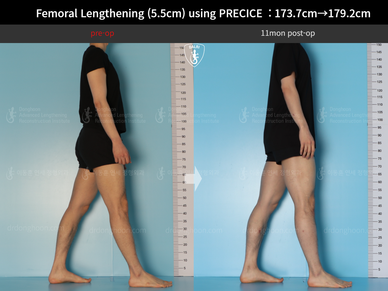 Before and after cll precice, case 18140453, image 3, Dr. Donghoon institute (DALRI)