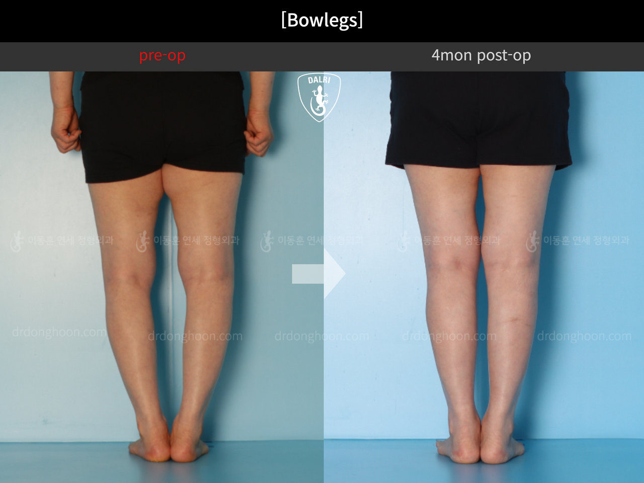 Before and after adult bowlegs, case 12586483, image 6, Dr. Donghoon institute (DALRI)