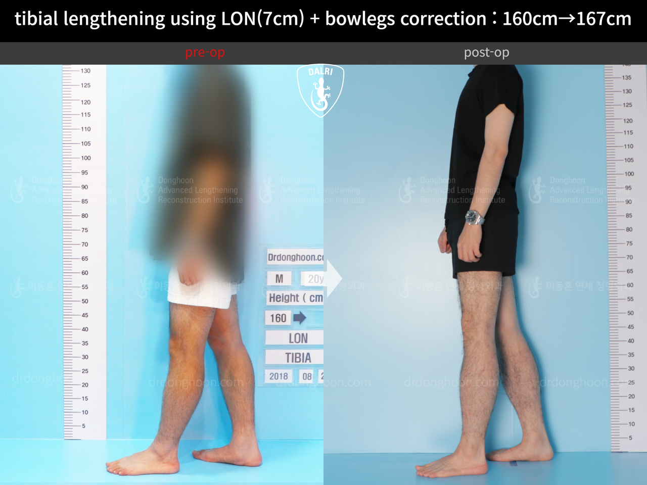 Before and after cll + deformity correction, case 13241722, image 3, Dr. Donghoon institute (DALRI)