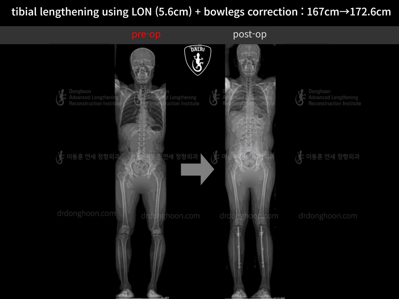 Before and after cll + deformity correction, case 12804946, image 9, Dr. Donghoon institute (DALRI)