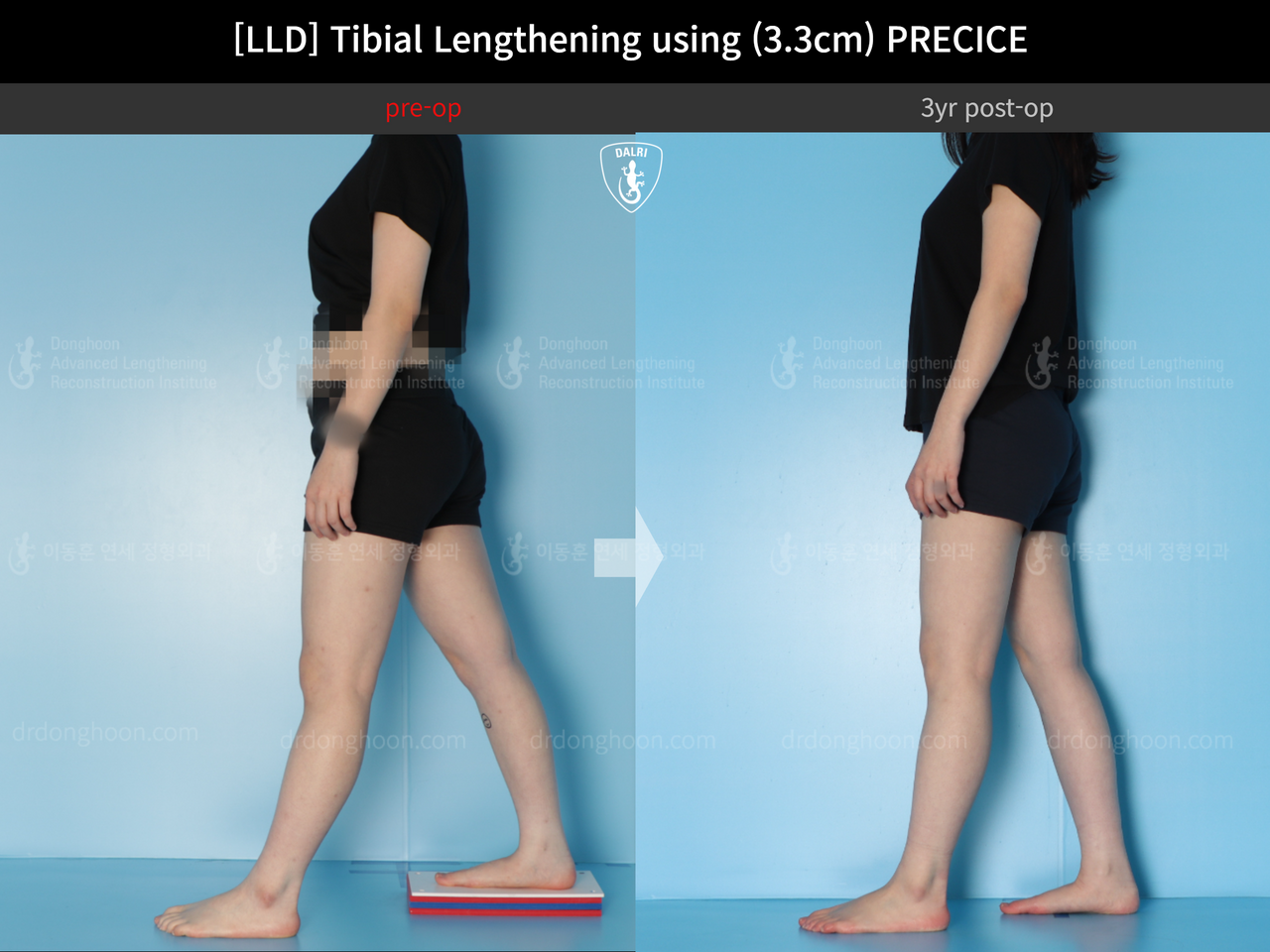 Before and after adult lld, case 14064905, image 5, Dr. Donghoon institute (DALRI)