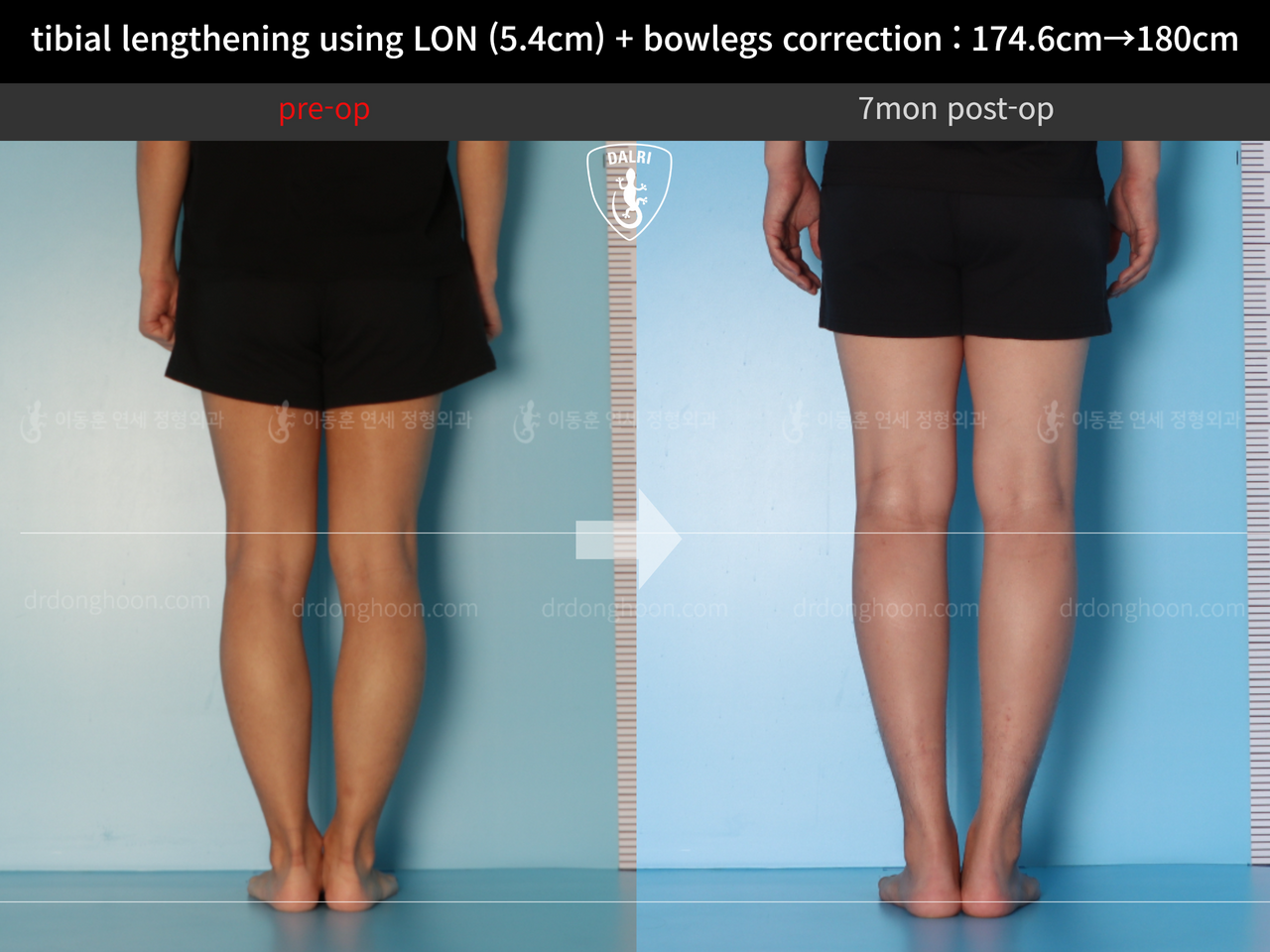 Before and after cll + deformity correction, case 12718558, image 8, Dr. Donghoon institute (DALRI)