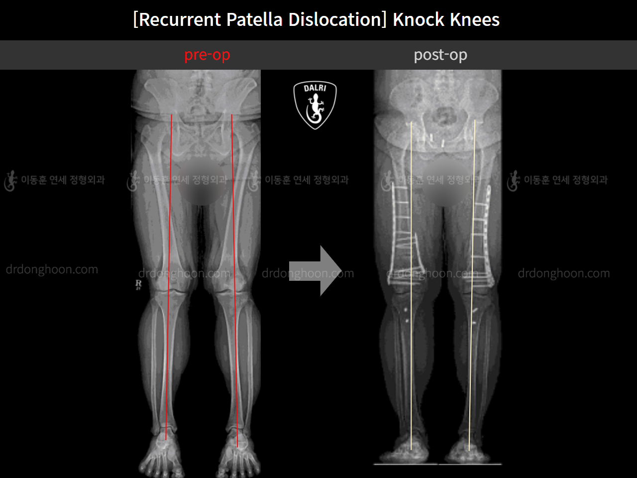 Before and after adult knock knees, case 10710317, image 8, Dr. Donghoon institute (DALRI)