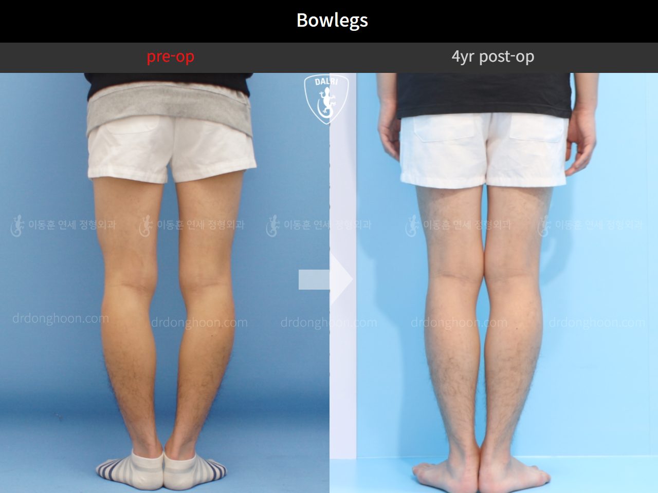Before and after adult bowlegs, case 4311360, image 8, Dr. Donghoon institute (DALRI)