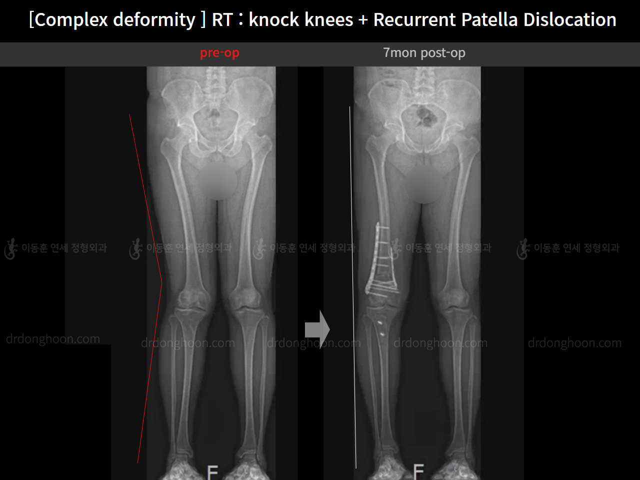 Before and after recurrent patella dislocation, case 16147031, image 14, Dr. Donghoon institute (DALRI)