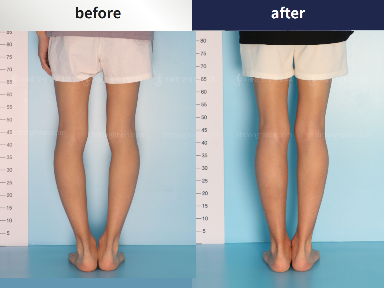 Before and after complex deformity, case 4297349, image 2, Dr. Donghoon institute (DALRI)