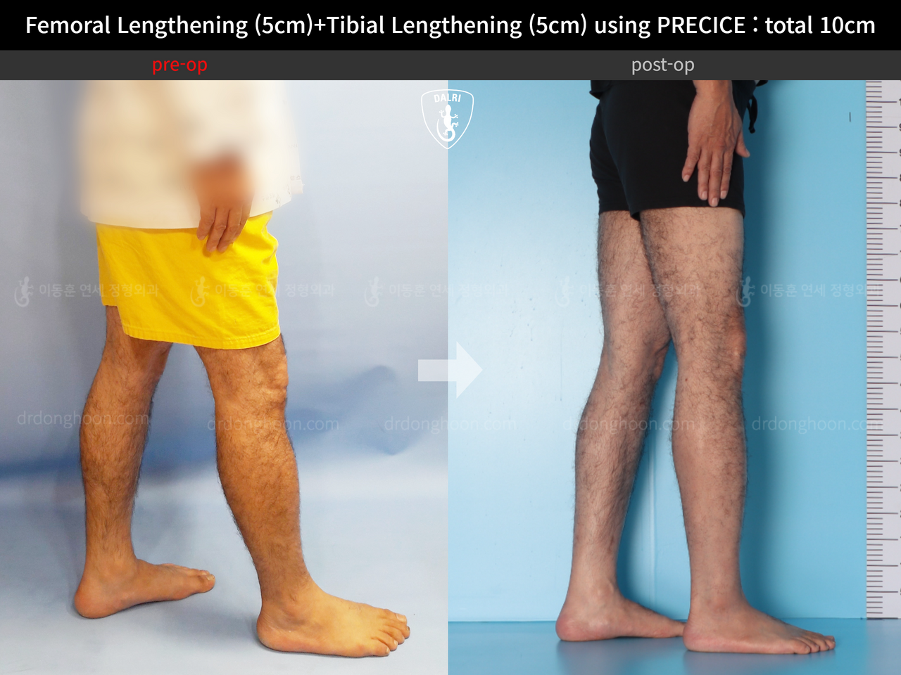 Before and after cll precice, case 13390688, image 8, Dr. Donghoon institute (DALRI)