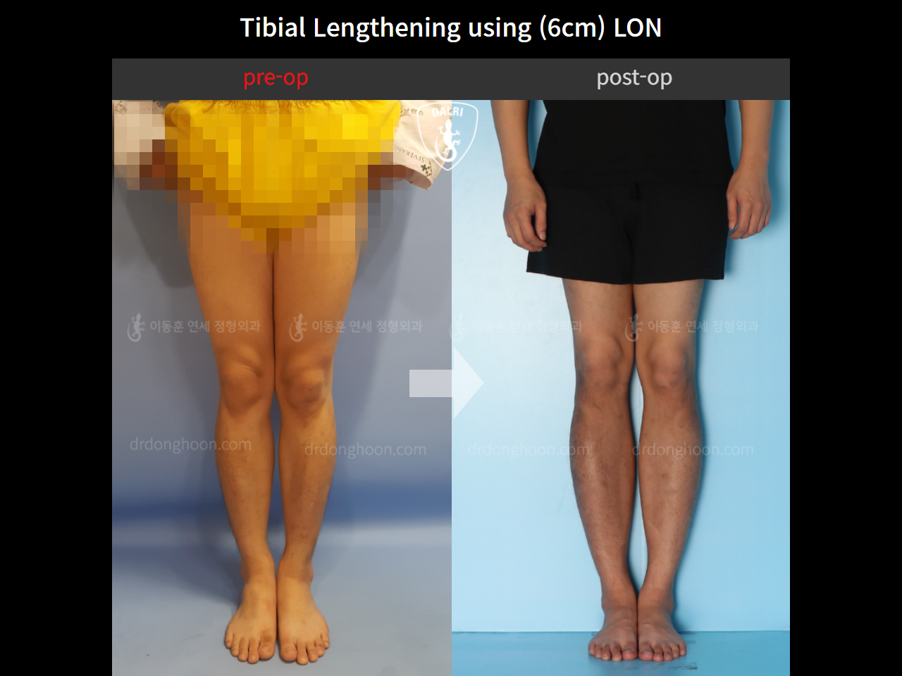 Before and after cll lon, case 11087271, image 5, Dr. Donghoon institute (DALRI)