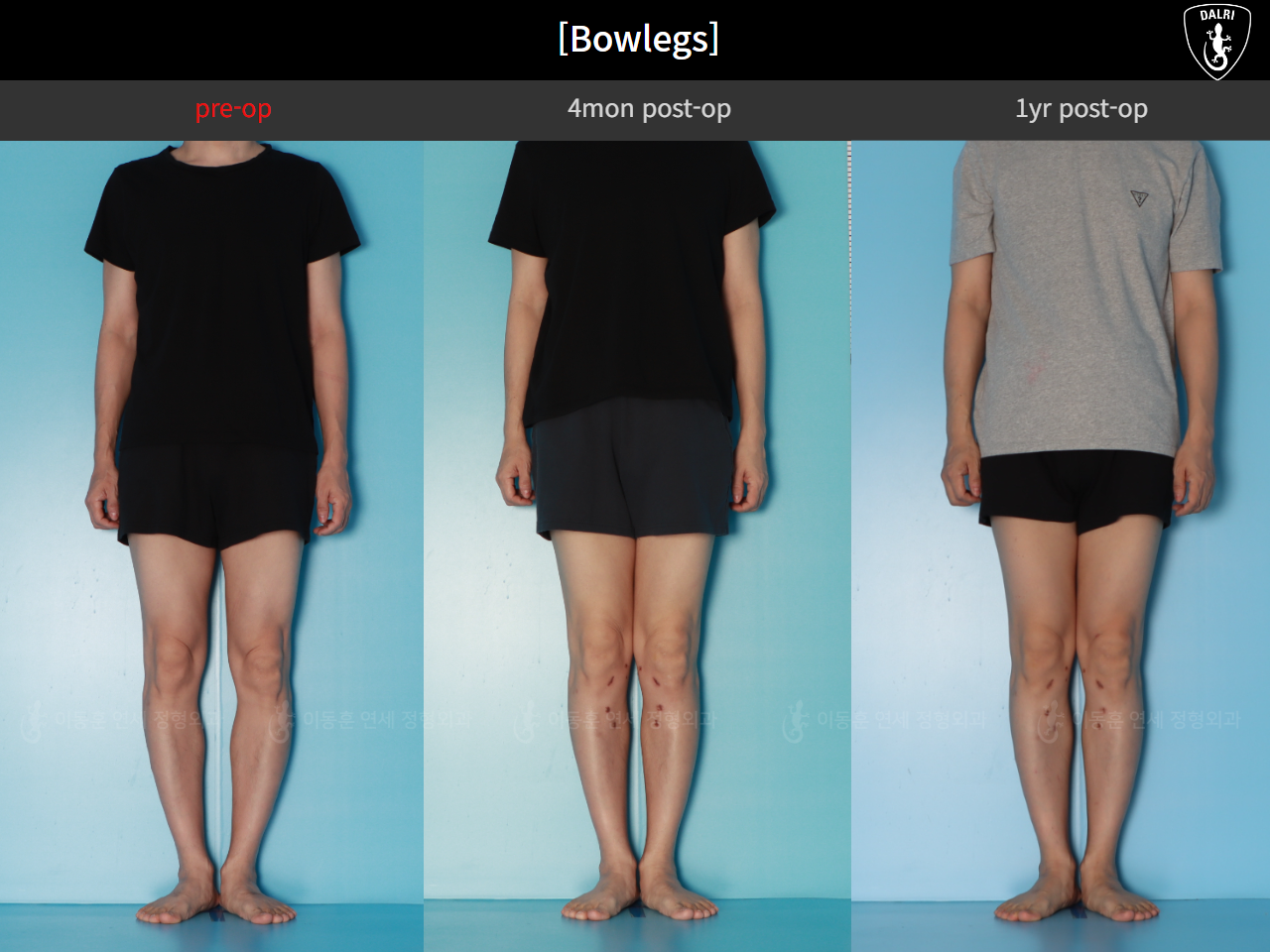 Before and after adult bowlegs, case 125438866, image 2, Dr. Donghoon institute (DALRI)