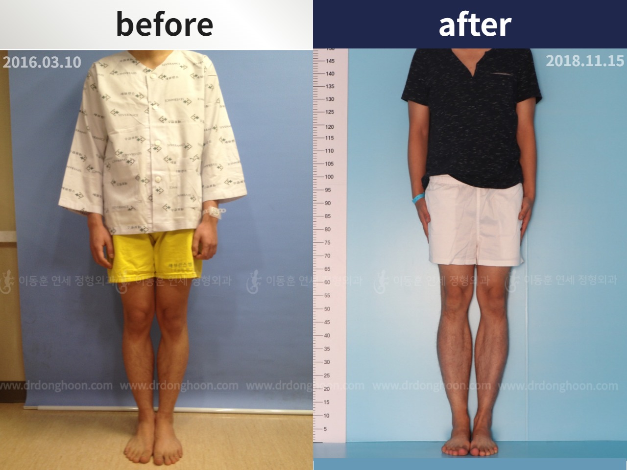 Before and after cll lon, case 4323449, image 2, Dr. Donghoon institute (DALRI)