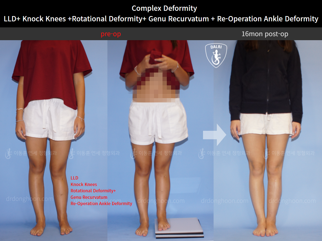 Before and after post-trauma deformity, case 10467603, image 1, Dr. Donghoon institute (DALRI)