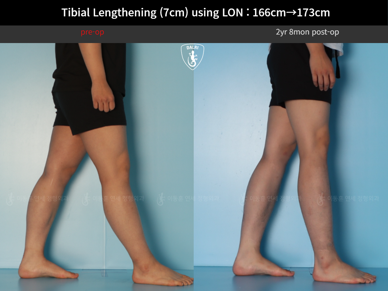 Before and after cll lon, case 127679780, image 8, Dr. Donghoon institute (DALRI)