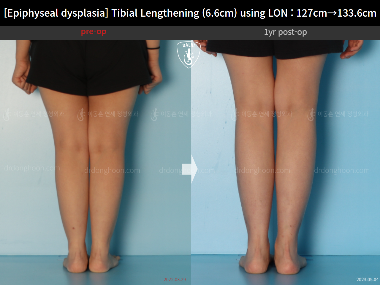 Before and after congenital condition, case 15072062, image 9, Dr. Donghoon institute (DALRI)
