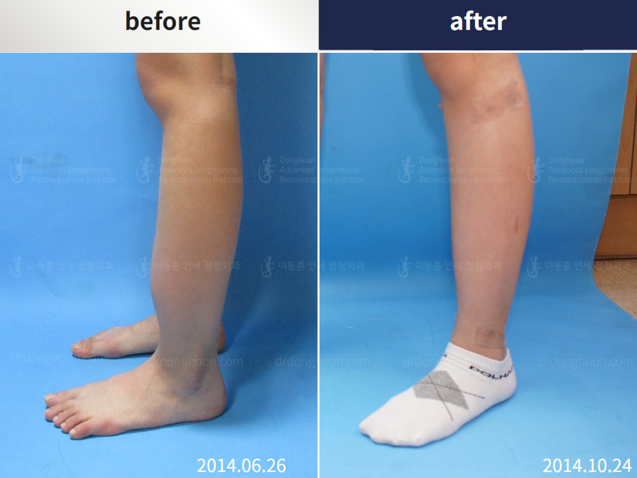 Before and after post-trauma deformity, case 4355008, image 5, Dr. Donghoon institute (DALRI)