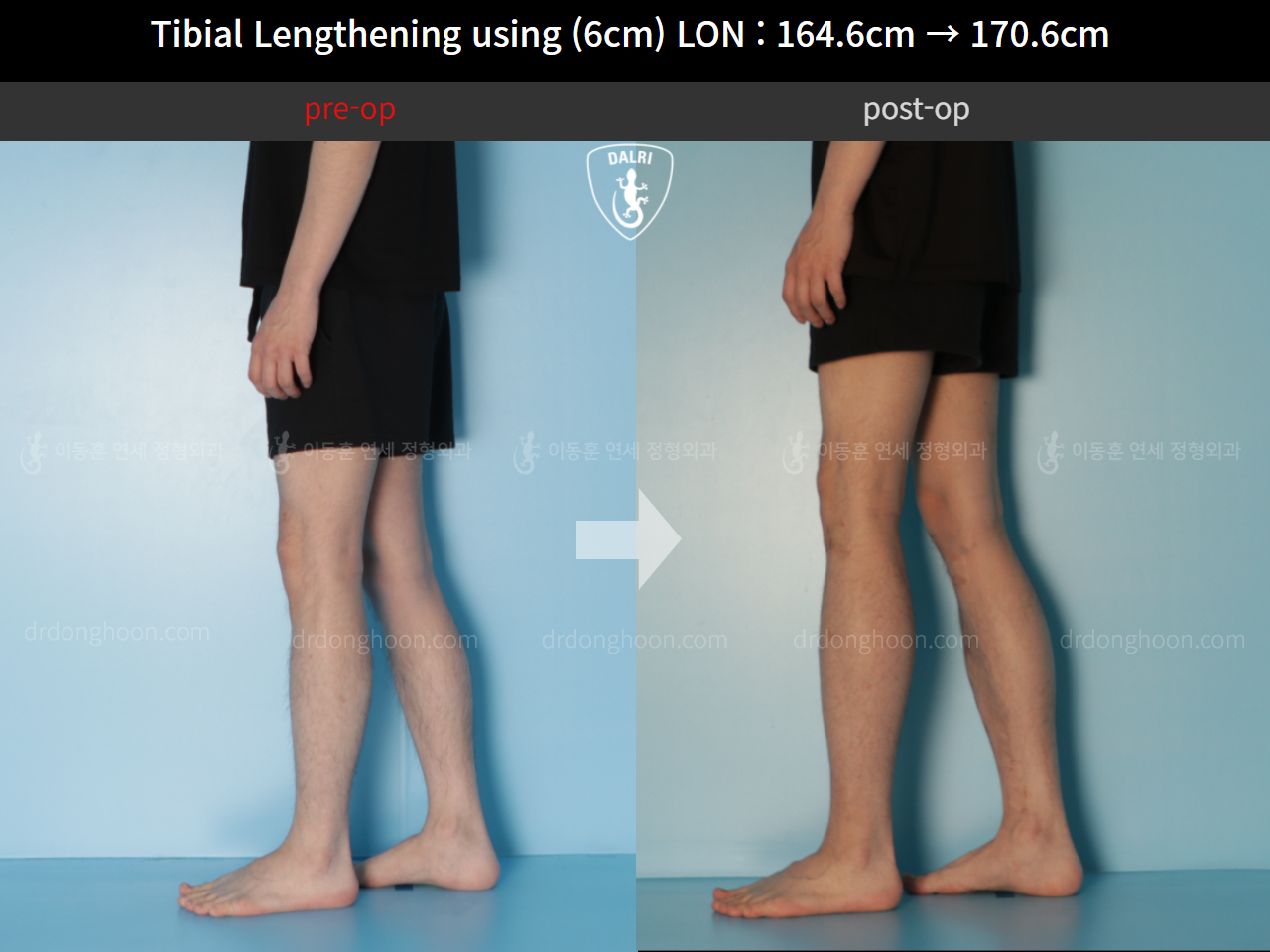Before and after cll lon, case 11674504, image 7, Dr. Donghoon institute (DALRI)