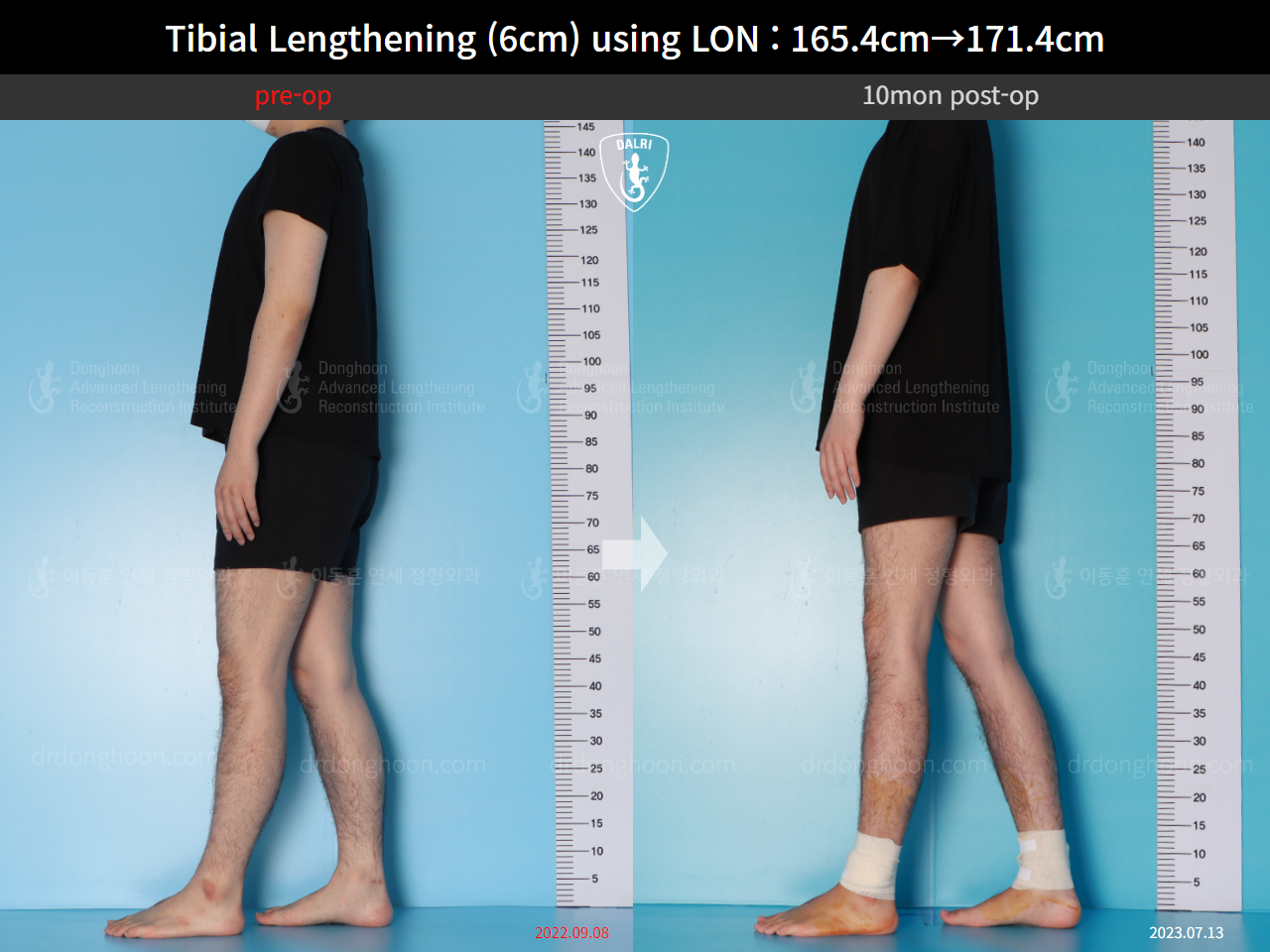 Before and after cll lon, case 15716525, image 5, Dr. Donghoon institute (DALRI)