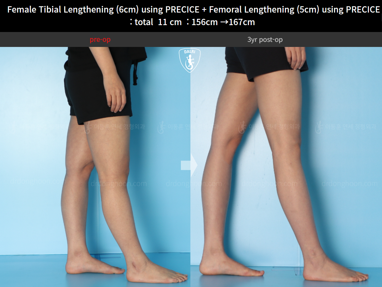 Before and after cll precice, case 24986271, image 8, Dr. Donghoon institute (DALRI)