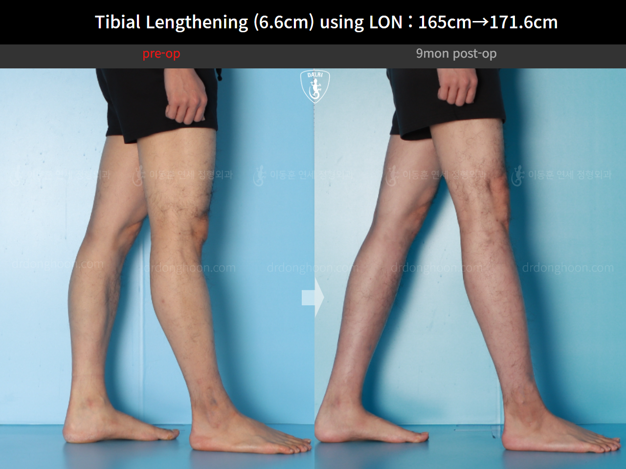 Before and after cll lon, case 16780660, image 12, Dr. Donghoon institute (DALRI)