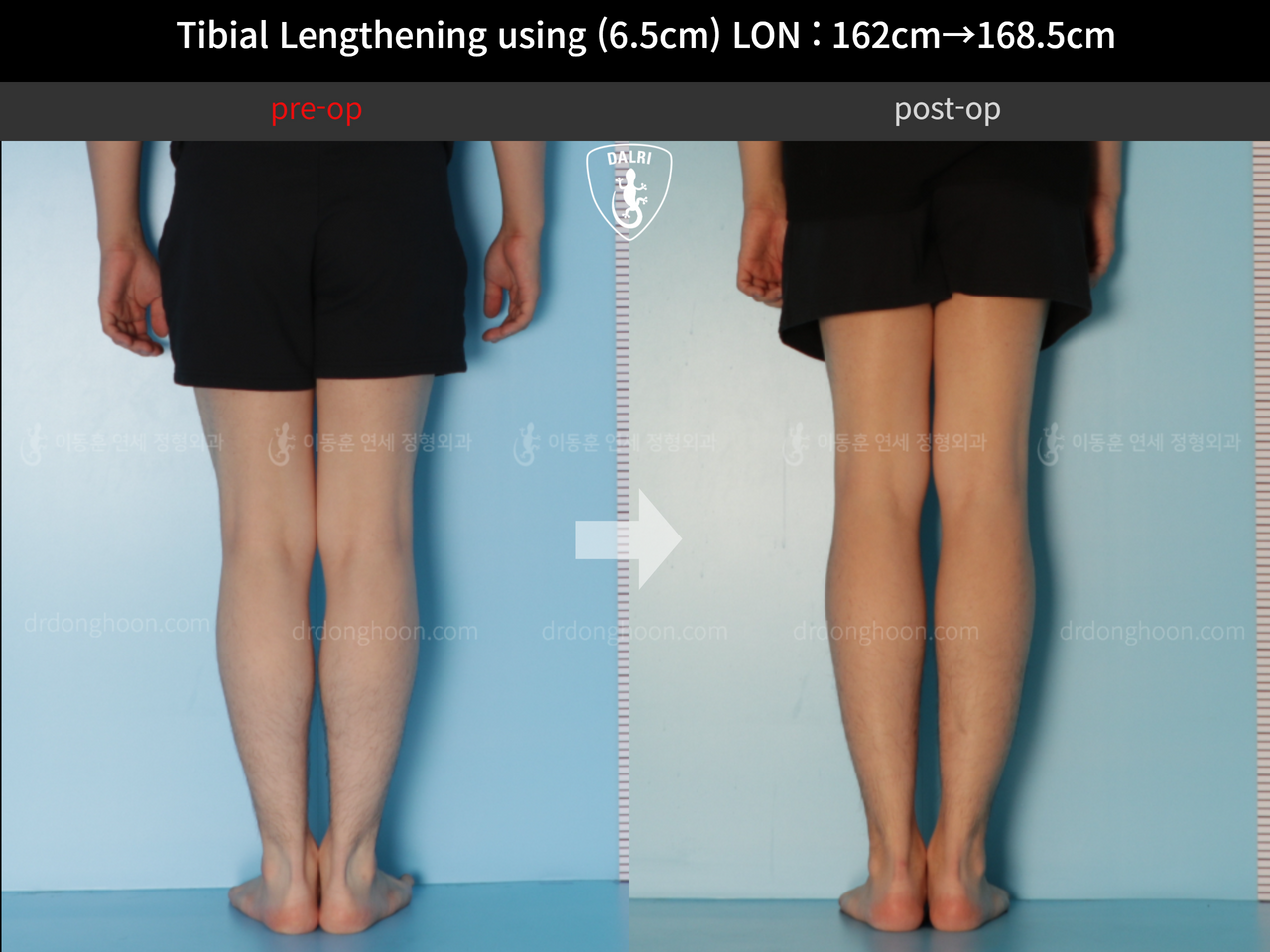 Before and after cll lon, case 11944171, image 6, Dr. Donghoon institute (DALRI)