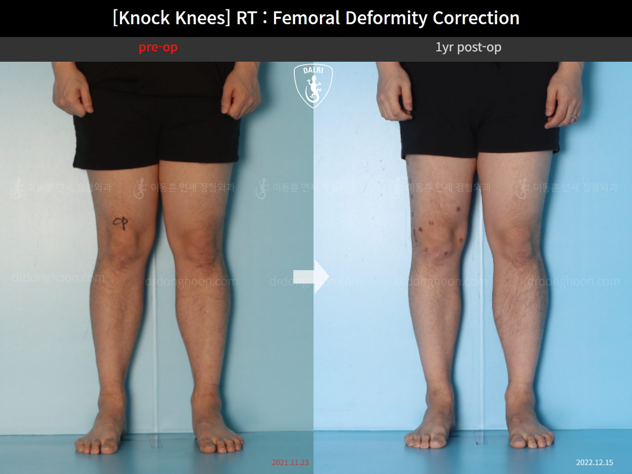 Before and after adult knock knees, case 15950751, image 10, Dr. Donghoon institute (DALRI)