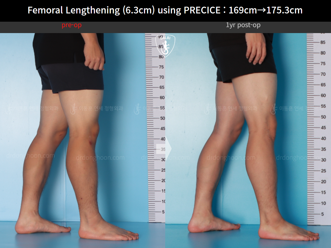 Before and after cll precice, case 16070058, image 12, Dr. Donghoon institute (DALRI)