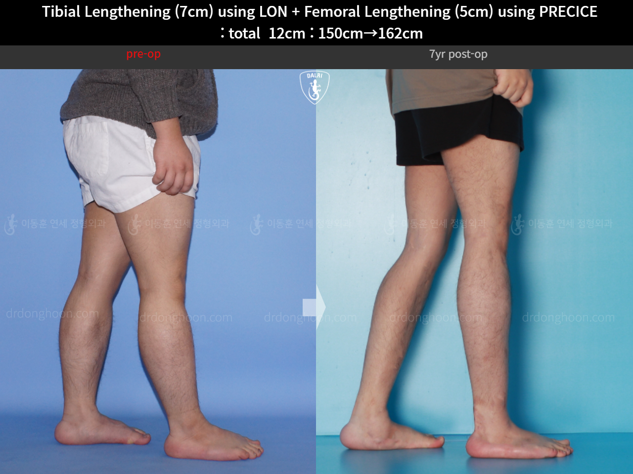 Before and after cll precice, case 16146445, image 11, Dr. Donghoon institute (DALRI)