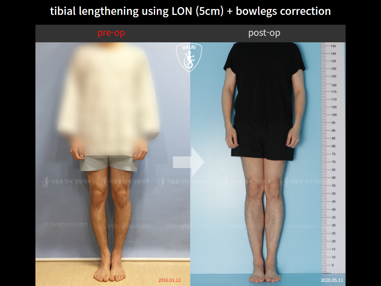 Before and after cll + deformity correction, case 4323130, image 1, Dr. Donghoon institute (DALRI)
