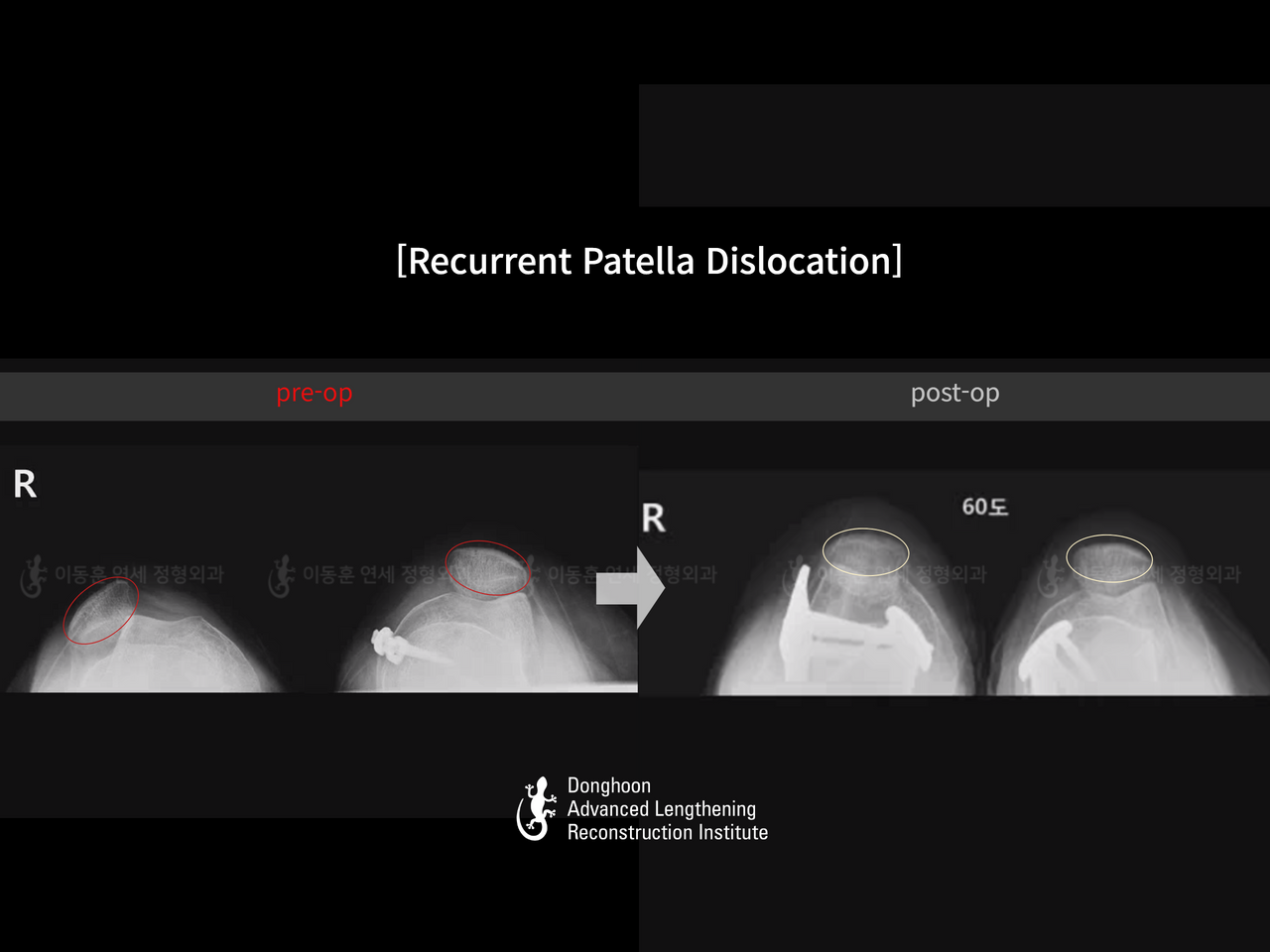 Before and after recurrent patella dislocation, case 14344405, image 6, Dr. Donghoon institute (DALRI)