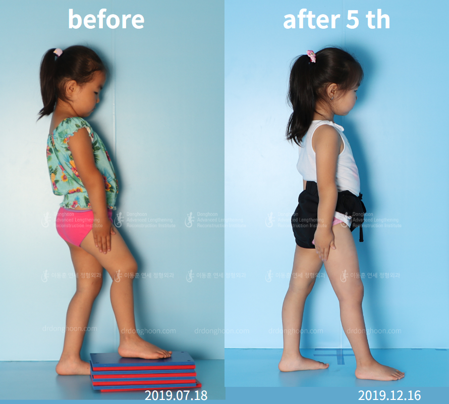 Before and after paediatric congenital condition, case 4304803, image 6, Dr. Donghoon institute (DALRI)