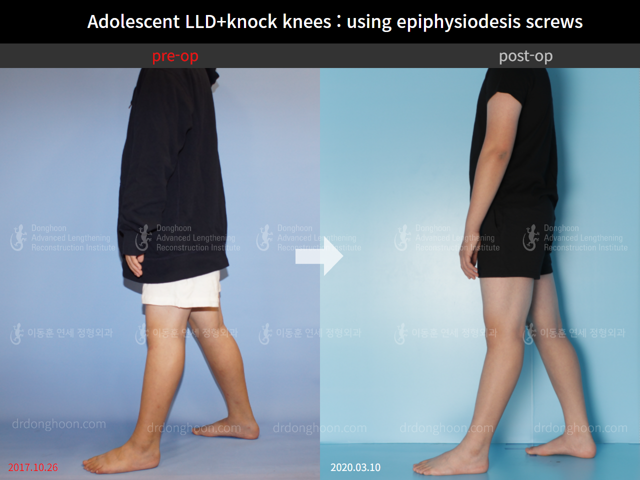 Before and after complex deformity, case 8835405, image 6, Dr. Donghoon institute (DALRI)