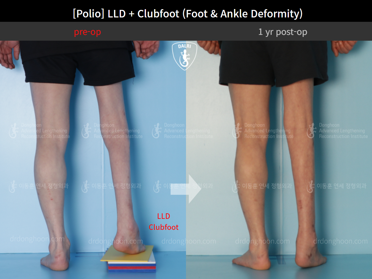 Before and after foot & ankle deformity, case 9231539, image 2, Dr. Donghoon institute (DALRI)