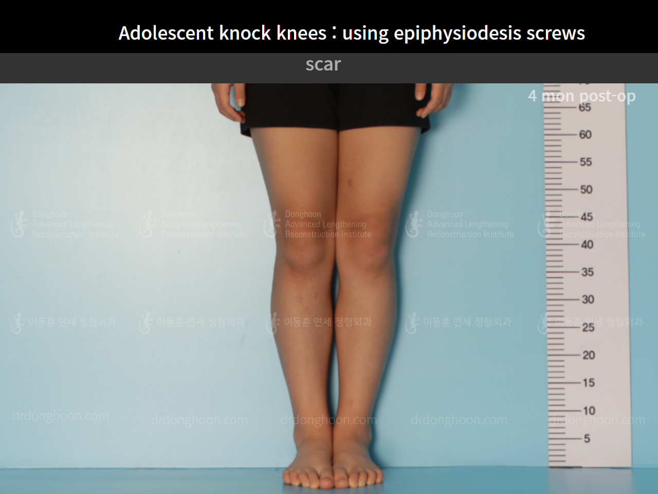 Before and after paediatric & adolescent knock knees, case 7977107, image 5, Dr. Donghoon institute (DALRI)