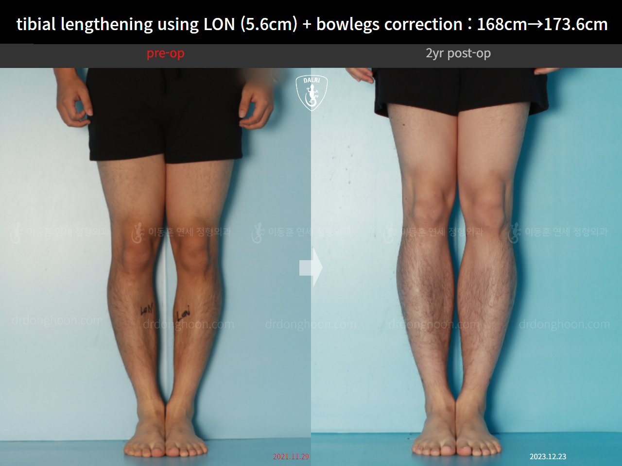 Before and after cll + deformity correction, case 17361975, image 5, Dr. Donghoon institute (DALRI)