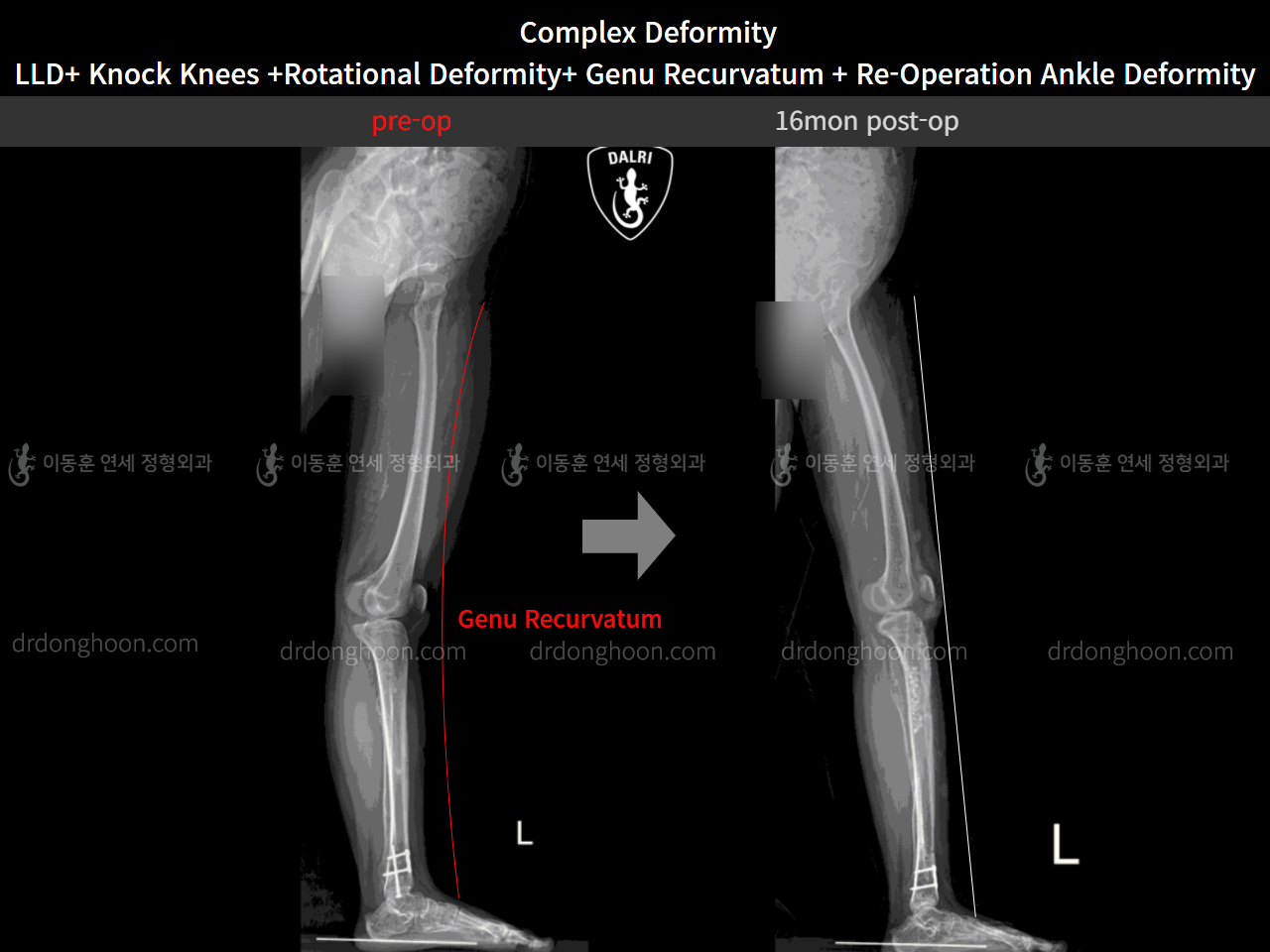Before and after adult lld, case 5301879, image 8, Dr. Donghoon institute (DALRI)