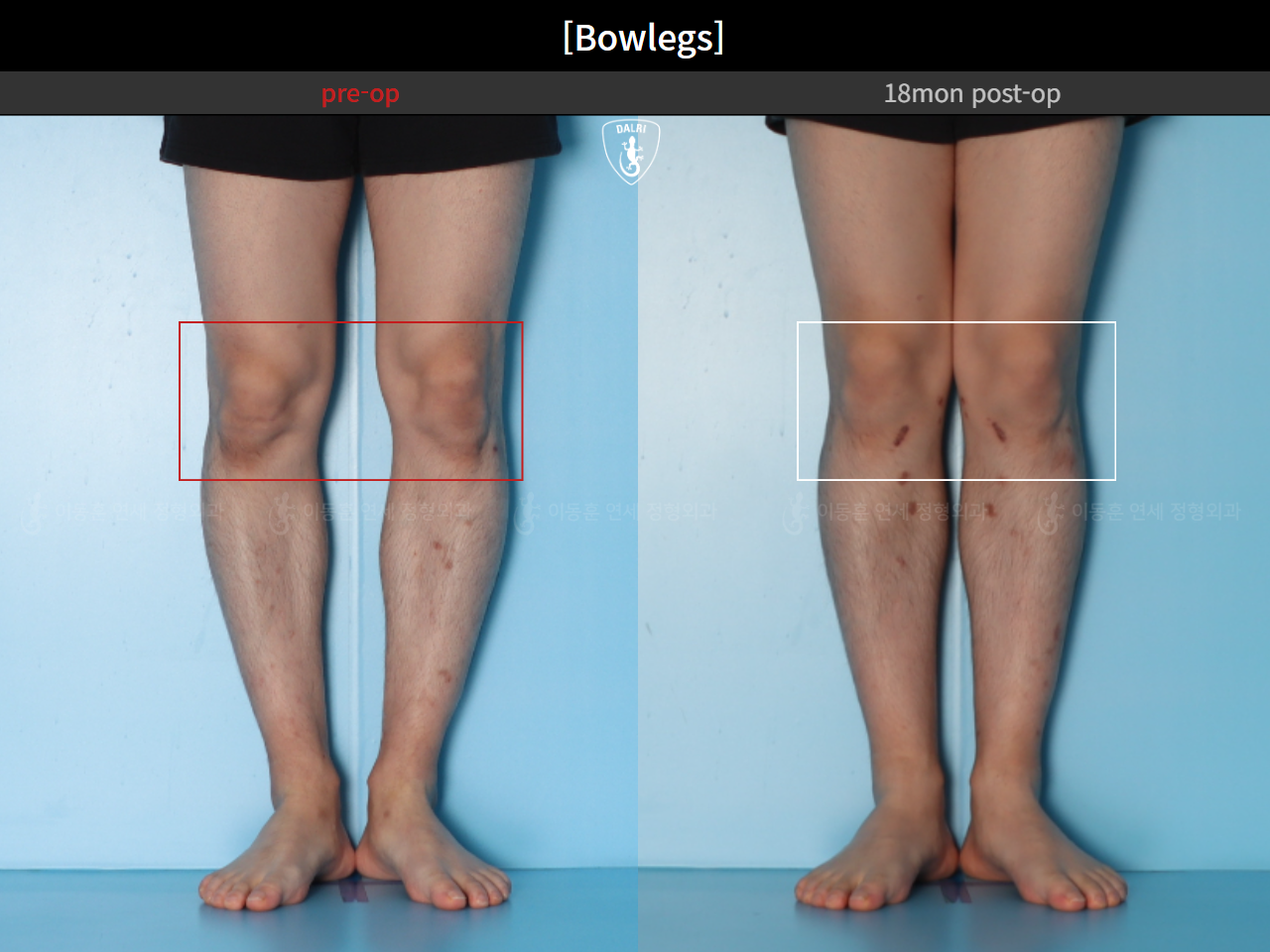Before and after adult bowlegs, case 94769040, image 9, Dr. Donghoon institute (DALRI)