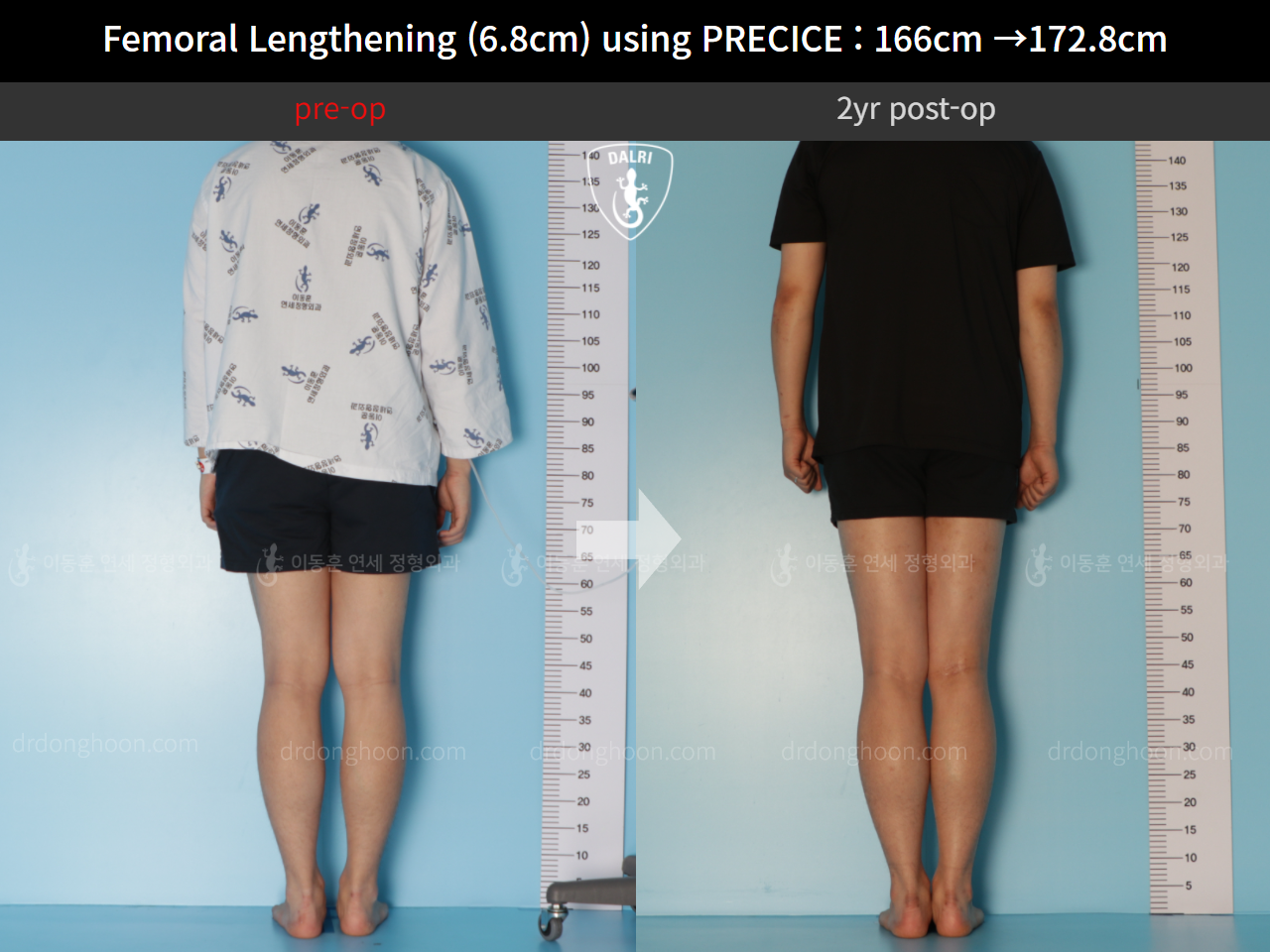 Before and after cll precice, case 10883099, image 2, Dr. Donghoon institute (DALRI)