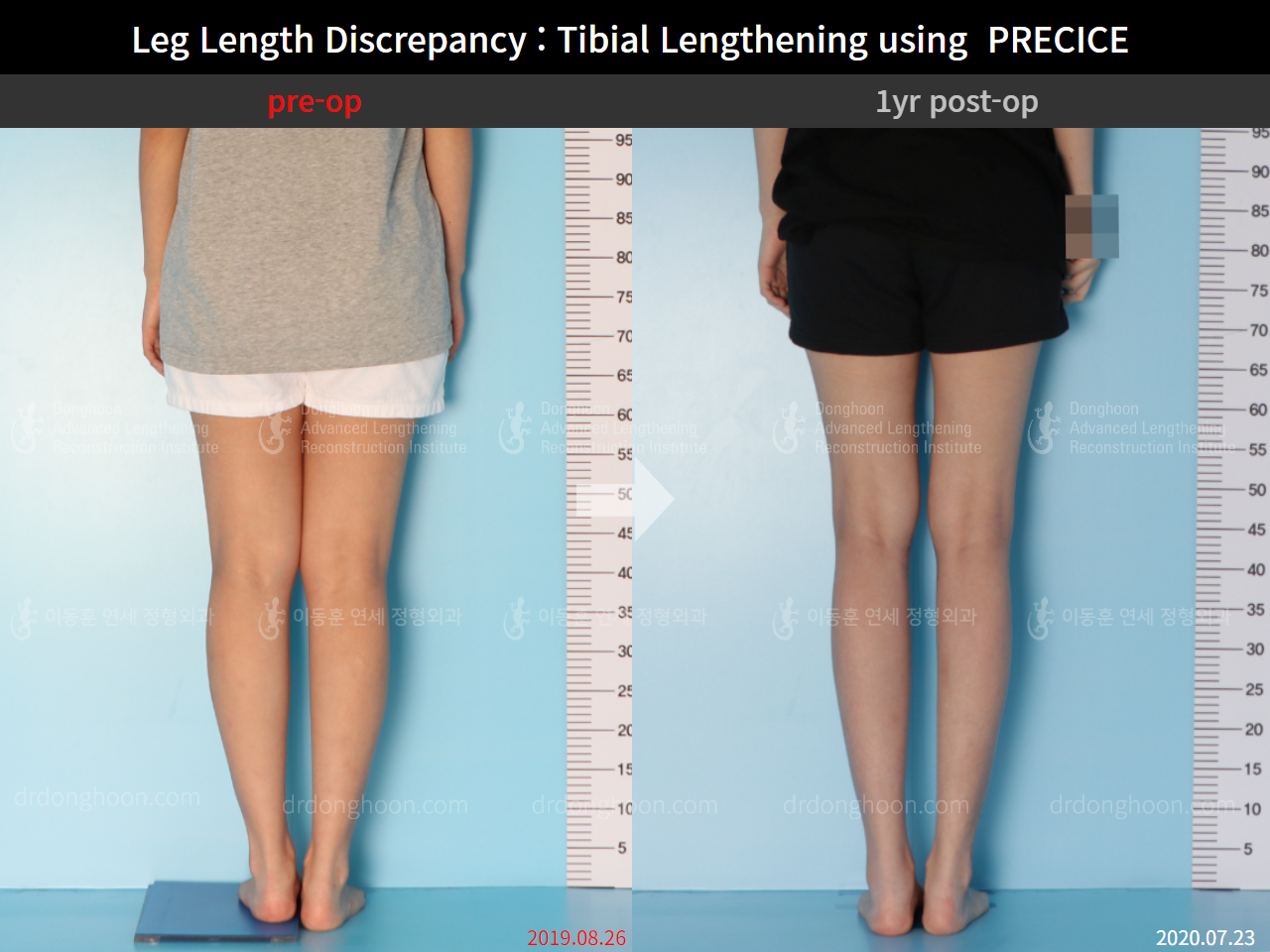 Before and after adult lld, case 8910234, image 4, Dr. Donghoon institute (DALRI)