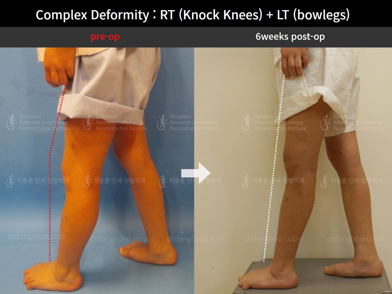 Before and after paediatric & adolescent knock knees, case 8618379, image 5, Dr. Donghoon institute (DALRI)