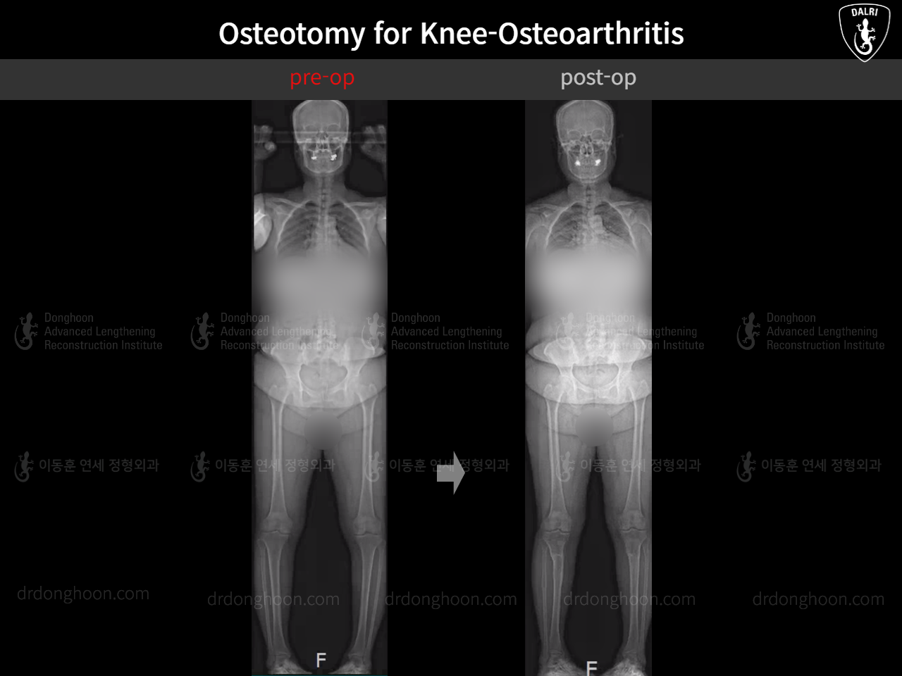Before and after osteotomy for knee osteoarthritis, case 16355985, image 3, Dr. Donghoon institute (DALRI)