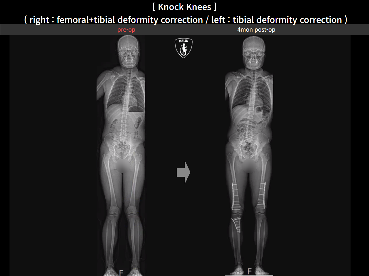 Before and after adult knock knees, case 22759789, image 1, Dr. Donghoon institute (DALRI)