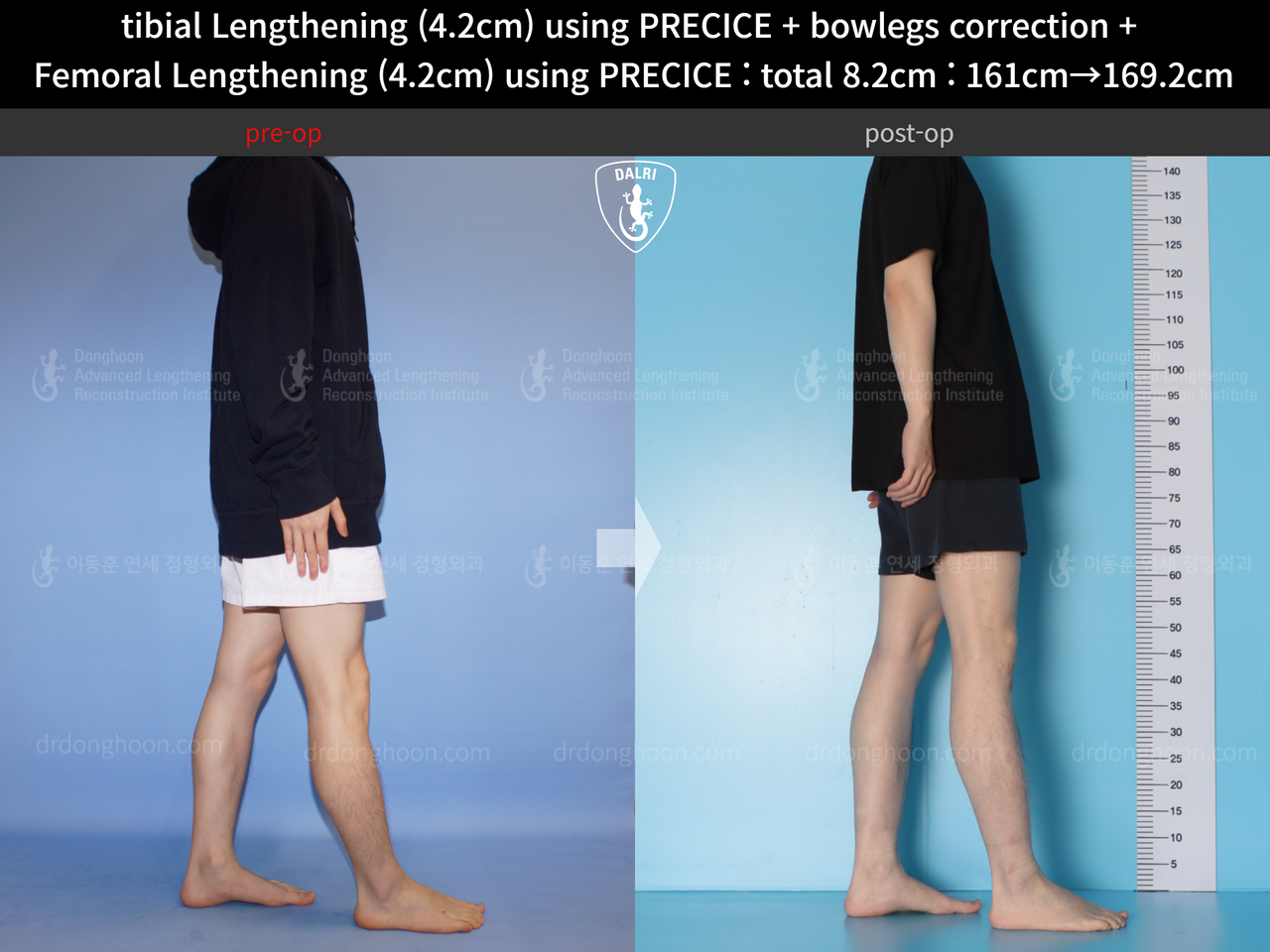 Before and after cll precice, case 14235714, image 3, Dr. Donghoon institute (DALRI)