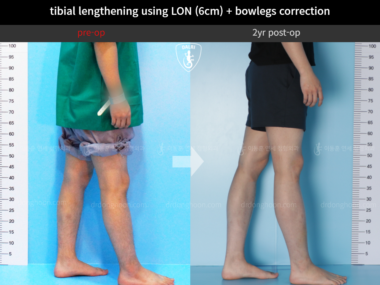 Before and after cll + deformity correction, case 4323141, image 7, Dr. Donghoon institute (DALRI)