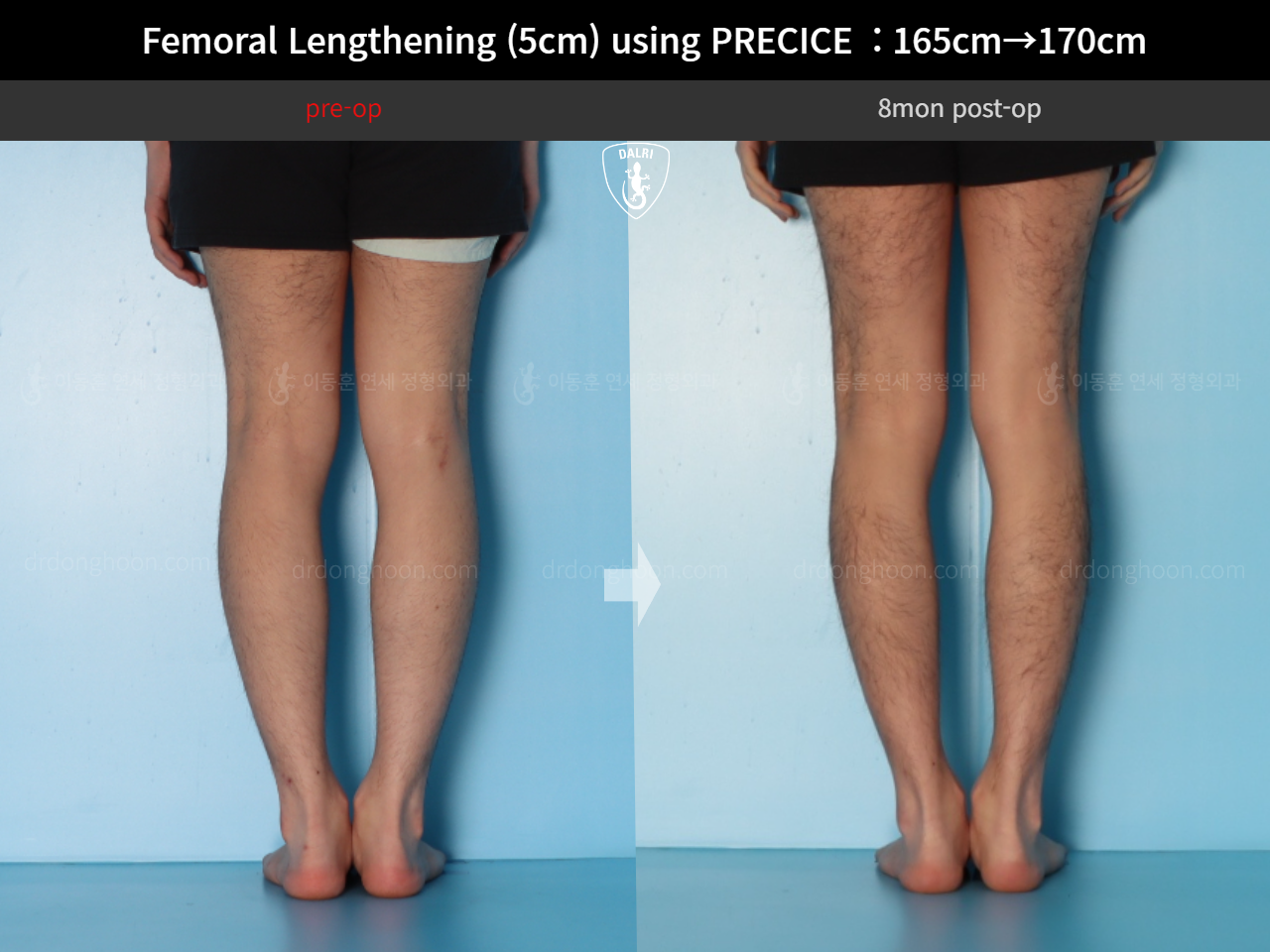 Before and after cll precice, case 18356944, image 8, Dr. Donghoon institute (DALRI)